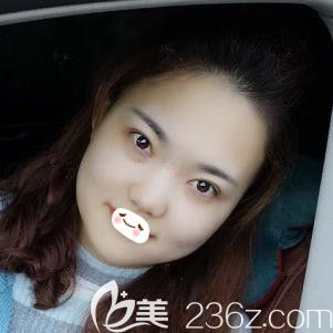 张柏松医生为我做切开双眼皮16天完全消肿