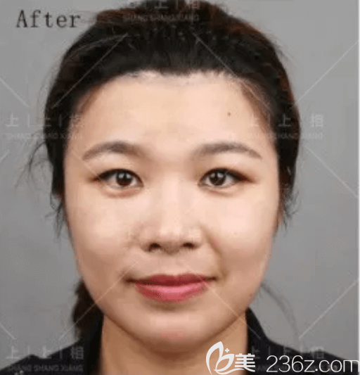 我在北京上上相做ART自体脂肪骨性移植技术改善凸嘴恢复中效果