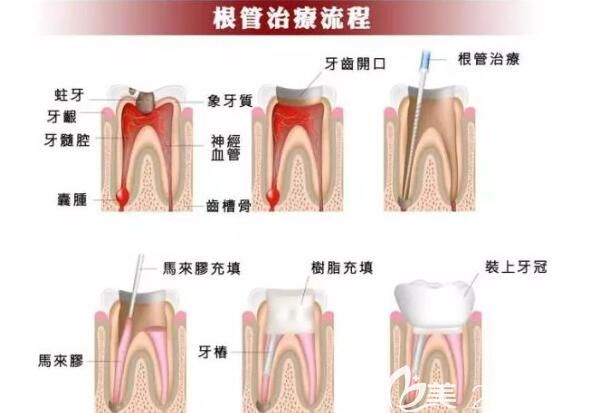 上海雅悦口腔吴圣辉医生告诉你：一个牙根管治疗要多久
