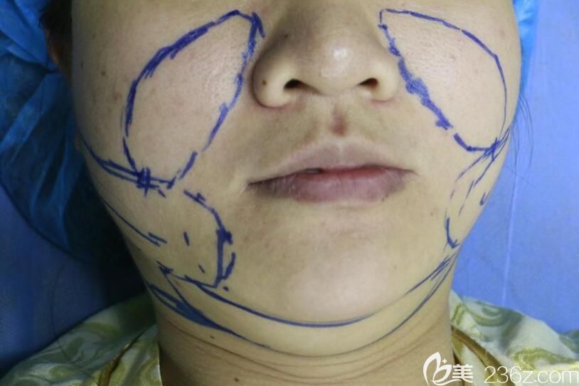 合肥华美吸脂瘦脸术前设计