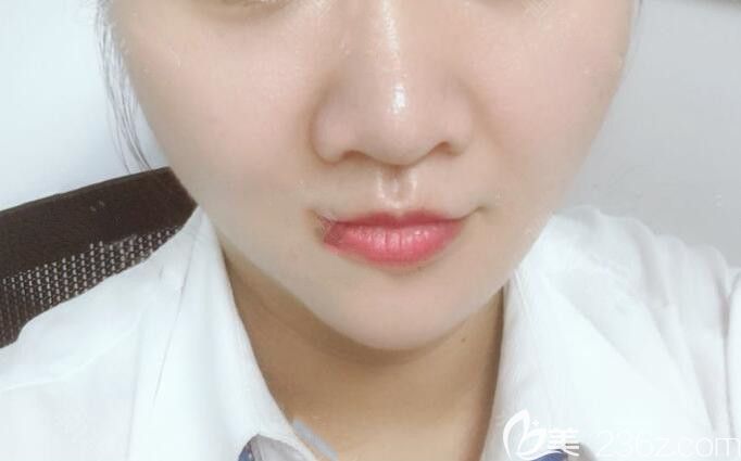 朱德纲做面部吸脂瘦脸术后33天效果图