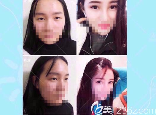 爱尚双眼皮案例展示