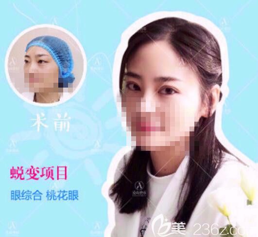 爱尚双眼皮案例