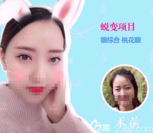 爱尚双眼皮前后对比