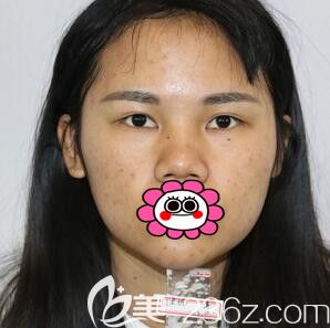 做自体软骨隆鼻术前照片 做自体软骨隆鼻术前照片