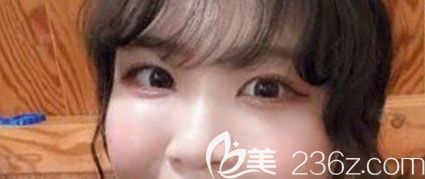 韩国奥纳比整形医院去眼袋术后1个月案例恢复图