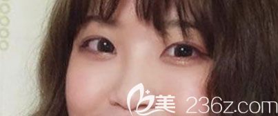 激光祛眼袋后悔死了，找韩国奥纳比整形医院张哲豪做眼底眶隔脂肪释放术后竟然拥有卧蚕