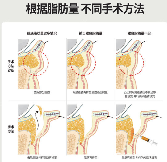 韩国奥纳比整形医院根据脂肪量用不同手术方法