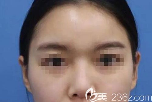 隆鼻手术前 隆鼻手术前