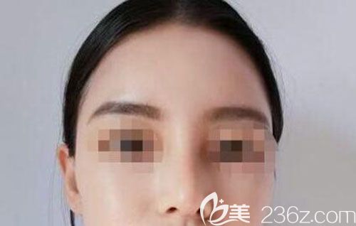 假体隆鼻第7天拆线没有任何外露的伤口和异物感 假体隆鼻第7天拆线没有任何外露的伤口和异物感