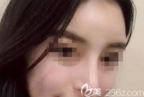 耳软骨垫鼻尖已经一个月颜值提升了几个台阶 耳软骨垫鼻尖已经一个月颜值提升了几个台阶