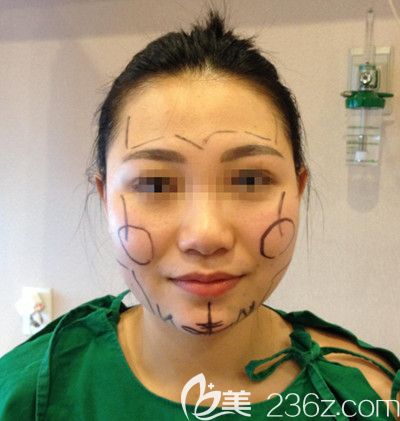在韩国small face整形医院做颧骨缩小+下颌角+脂肪填充手术设计