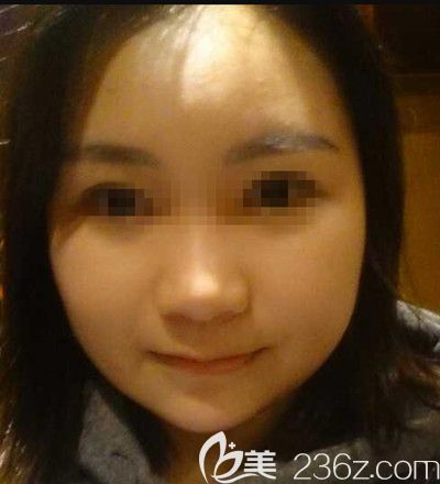 在韩国small face整形医院做颧骨缩小+下颌角+脂肪填充术后2周