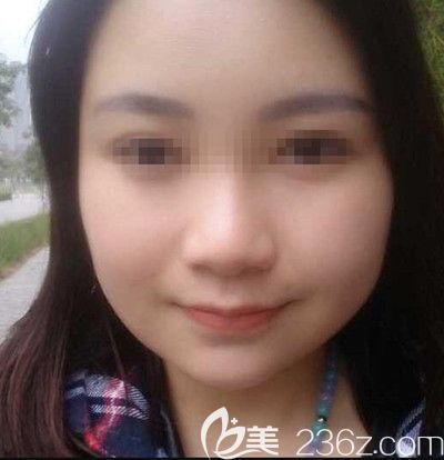 在韩国small face整形医院做颧骨缩小+下颌角+脂肪填充术后2个月