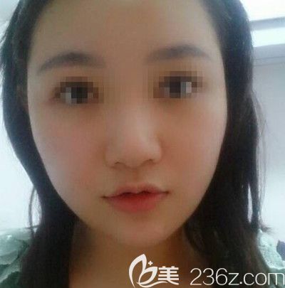 在韩国small face整形医院做颧骨缩小+下颌角+脂肪填充术后4个月