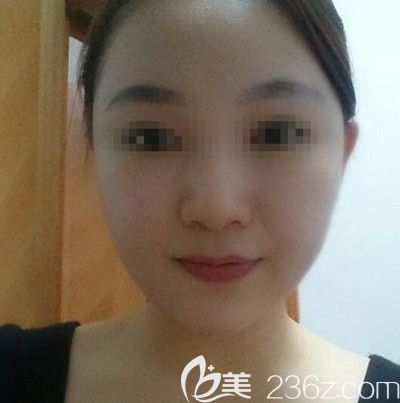 分享我在韩国small face整形医院做颧骨缩小+下颌角+脂肪填充半年的恢复效果
