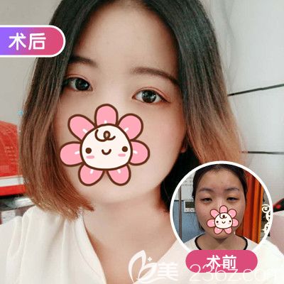 武汉美基元做双眼皮术前术后对比 武汉美基元做双眼皮术前术后对比