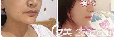 美基元注射瘦脸术后30天恢复效果 美基元注射瘦脸术后30天恢复效果