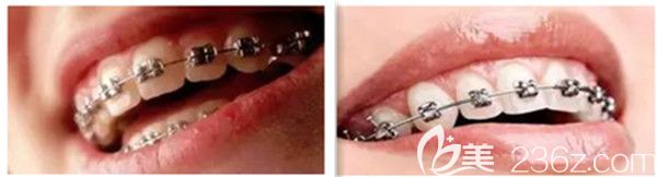 自锁托槽和普通托槽的区别