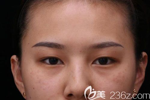 祛斑手术前 祛斑手术前
