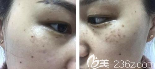 激光祛斑第7天脸上痂已经脱落 激光祛斑第7天脸上痂已经脱落