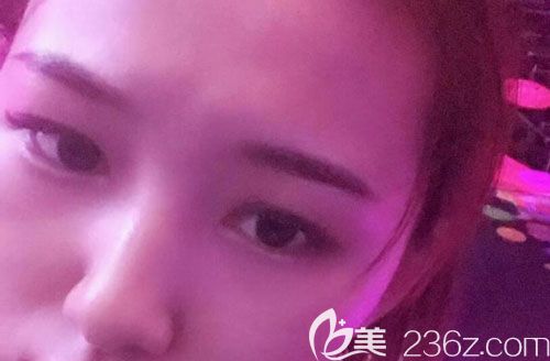 皮秒激光祛斑第15天皮肤越来越有光泽 皮秒激光祛斑第15天皮肤越来越有光泽