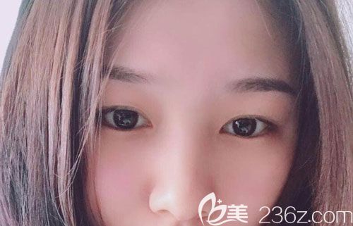 曲靖激光祛斑哪家医院做的好?曲靖靖美赵锡泰皮秒激光祛斑一个月后让我不再是小黑妹了