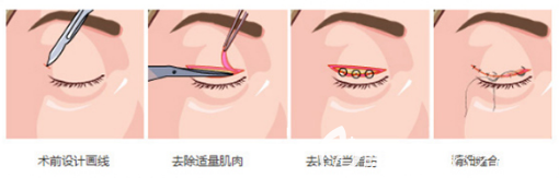深圳丽港丽格双眼皮手术过程图