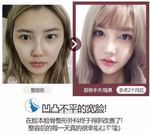 朴用南院长轮廓真人案例 朴用南院长轮廓真人案例