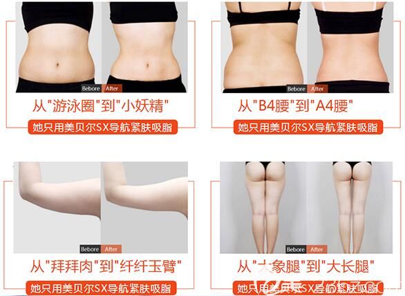 扬州美贝尔SX导航吸脂案例对比 扬州美贝尔SX导航吸脂案例对比