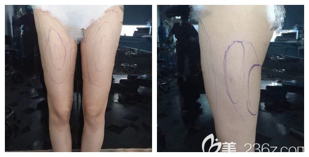 面诊扬州美贝尔术前大粗腿明显 面诊扬州美贝尔术前大粗腿明显