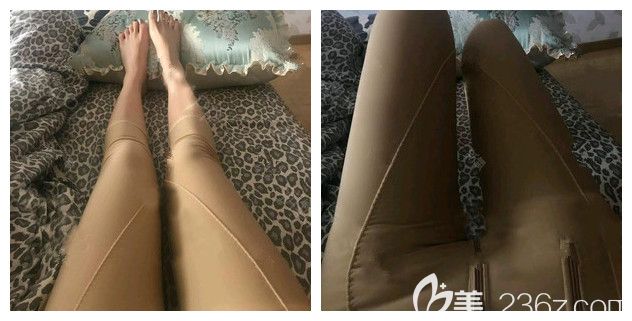 做完大腿吸脂术后三天穿着塑身衣 做完大腿吸脂术后三天穿着塑身衣