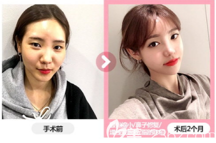 公开我在韩国脸本脸骨整形外科朴用南做颧骨鼻子修复脂肪移植价格