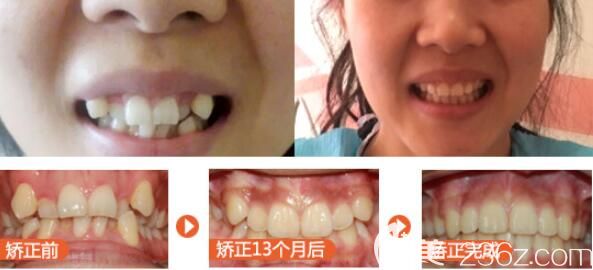 美莱口腔怎么样?特呈上顾客真人矫正案例 美莱口腔怎么样?特呈上顾客真人矫正案例