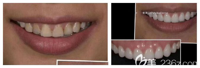 超薄瓷贴面修复牙齿前后效果对比