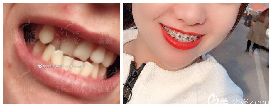 美莱口腔牙齿拥挤不齐矫正案例前后对对比照片 美莱口腔牙齿拥挤不齐矫正案例前后对对比照片