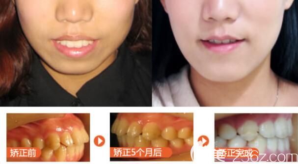 凸嘴龅牙矫正过程中正面脸型的变化图