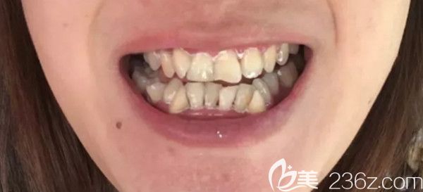 刚带上第1副隐形牙套的照片 刚带上第1副隐形牙套的照片