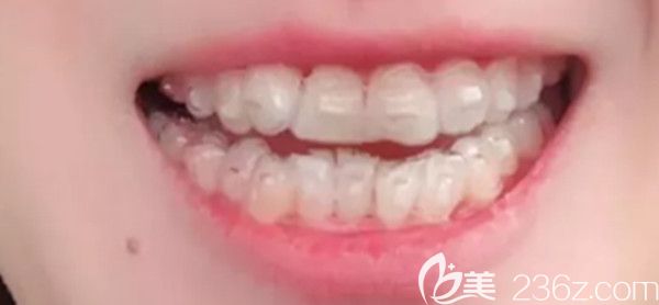 戴牙套的第六个月,牙齿变得整齐了 戴牙套的第六个月,牙齿变得整齐了