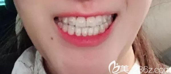 戴牙套的第十个月变化图 戴牙套的第十个月变化图