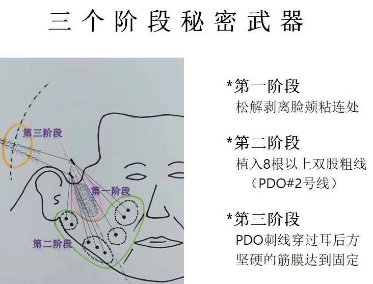 朴明旭院长分阶段埋线提升示意图