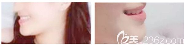 隐形牙套前后侧脸及下巴对比照片 隐形牙套前后侧脸及下巴对比照片
