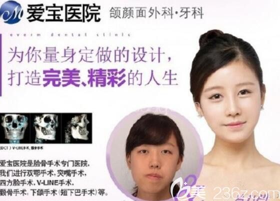 韩国爱宝颌面案例