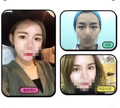 洛阳毛大夫双眼皮前后对比照片