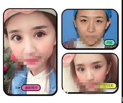 洛阳毛大夫双眼皮前后对比照片