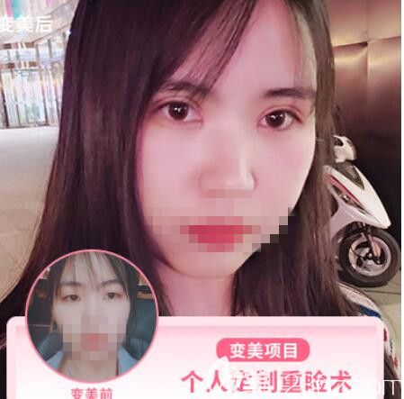 普潇医生做的眼部整形