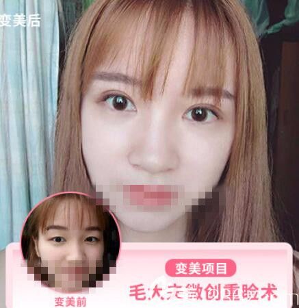 普潇医生做的眼部整形