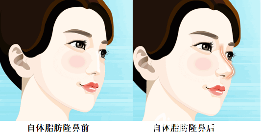 自体脂肪隆鼻前后对比效果图