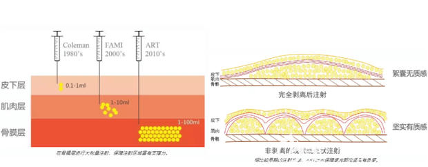 北京上上相ART技术做自体脂肪隆鼻注射过程示意图