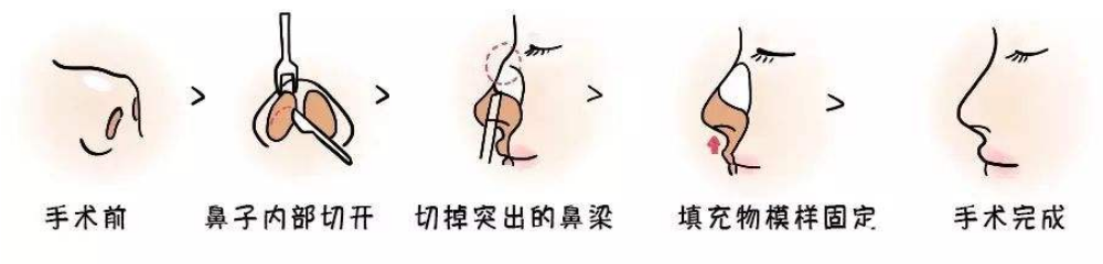 驼峰鼻矫正示意图
